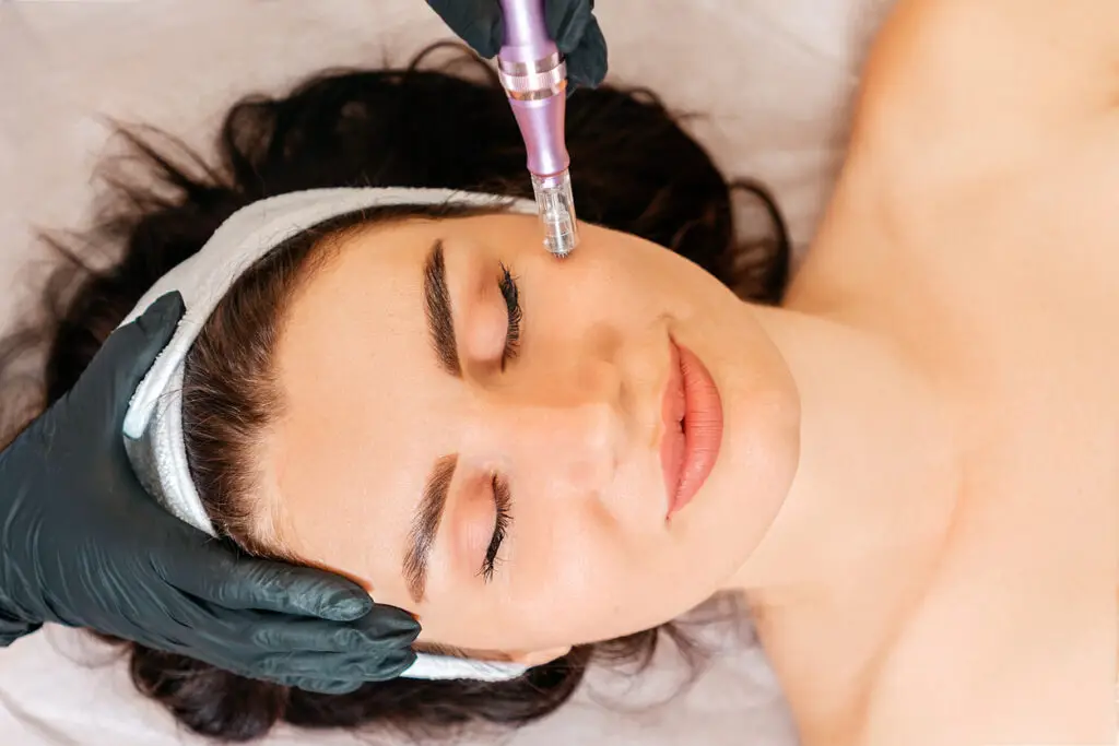 Microneedling Does to Your Face and Skin Appearance