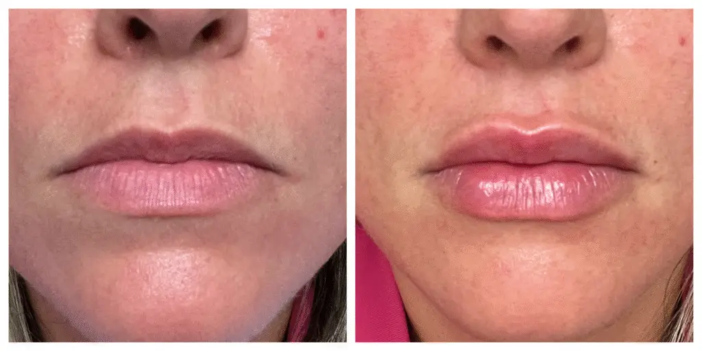 Before and after Juvederm