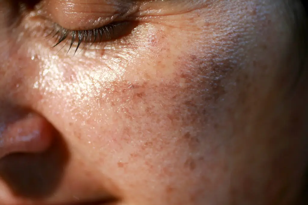 Sun Damage Treatment