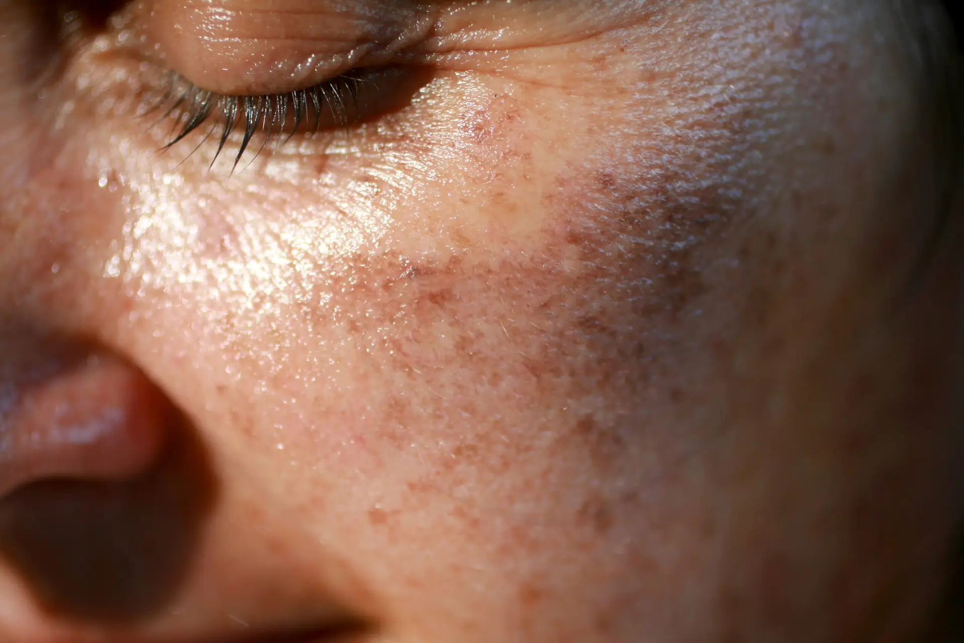 Sun Damage Treatment