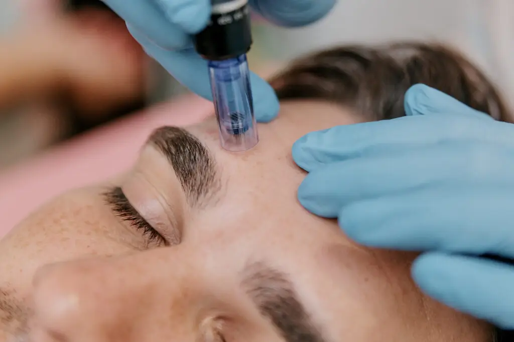 microneedling kennesaw