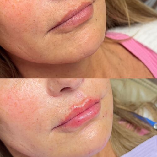 Injectables B&A - lip filler