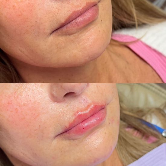 Injectables B&A - lip filler