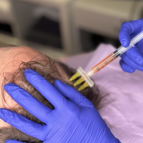 PRF for scalp